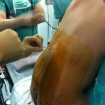 La epidural se suele administrar cuando el cuello de la matriz está dilatado unos 4cm en mujeres primíparas y menos de 4 cm en multíparas.