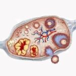 Los tratamientos del cáncer de ovario dependen del tipo de cáncer y del estadiaje de la enfermedad.