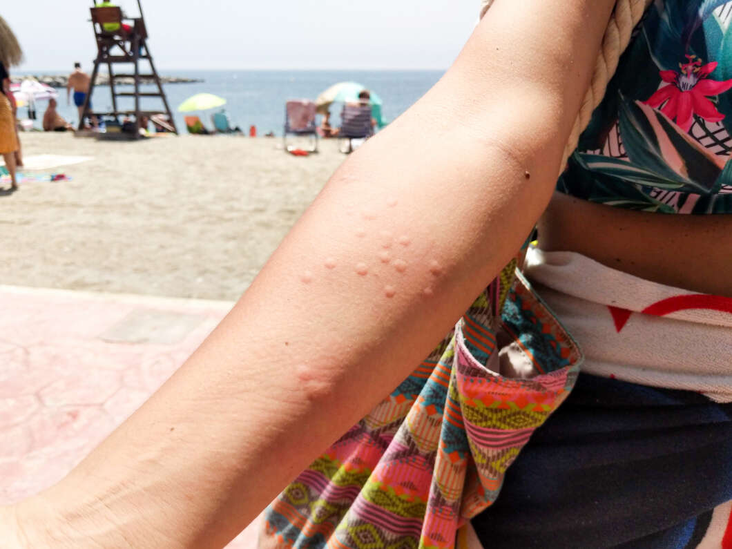 Close-up of a forearm with multiple small red insect bites, resting on a colorful patterned towel at the beach with the ocean in the background.
