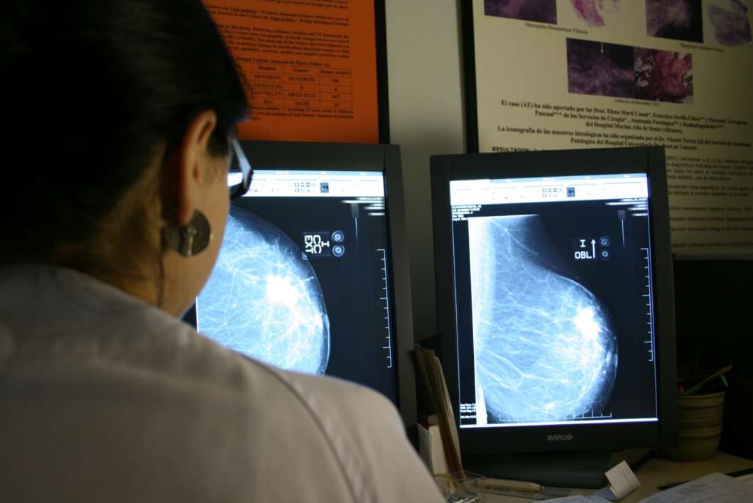 Castellón detecta 210 casos de cáncer de mama en 2025 a través del cribado