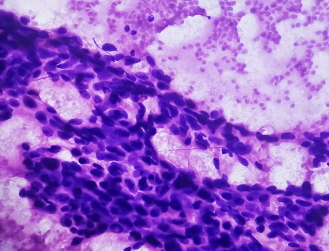 tumor mamario, carcinoma ductal, estudio, cáncer,
